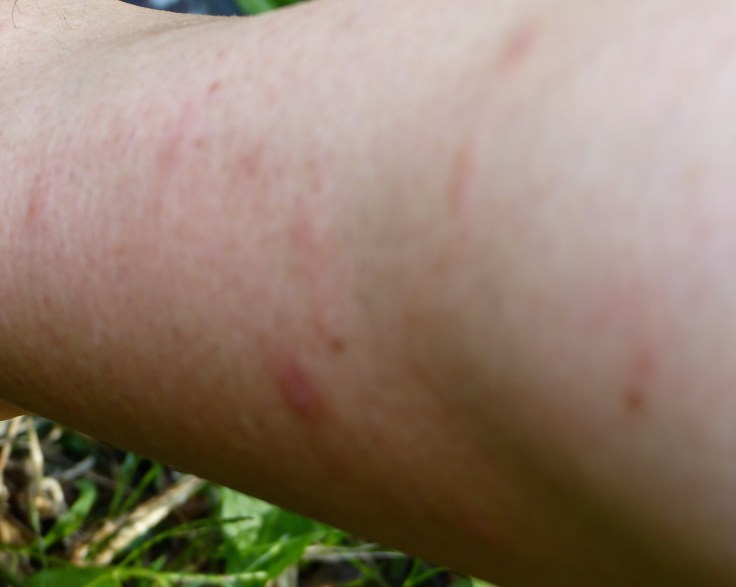 A small patch of what I received in the first few seconds of arriving! Multiply that up my legs and arms and I was a slightly uncomfortable camper! 